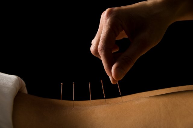 Akupunktur - © Yanik Chauvin - Fotolia.com